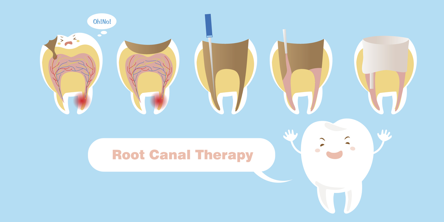 endodontic-treatment-root-canal
